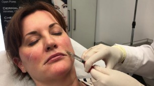 'Nose to mouth lines at Persona Cosmetic Medicine'