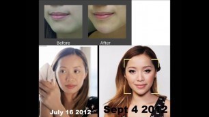 'Michelle Phan plastic surgery? Proof'