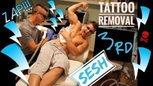 'Tattoo Removal 3rd Sesh'
